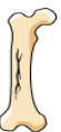 <p>Type of fracture? </p>