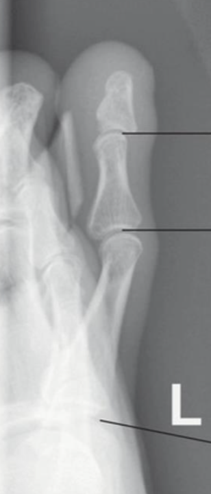 <p>how would you descirbe the concavity of the lateral toe</p>
