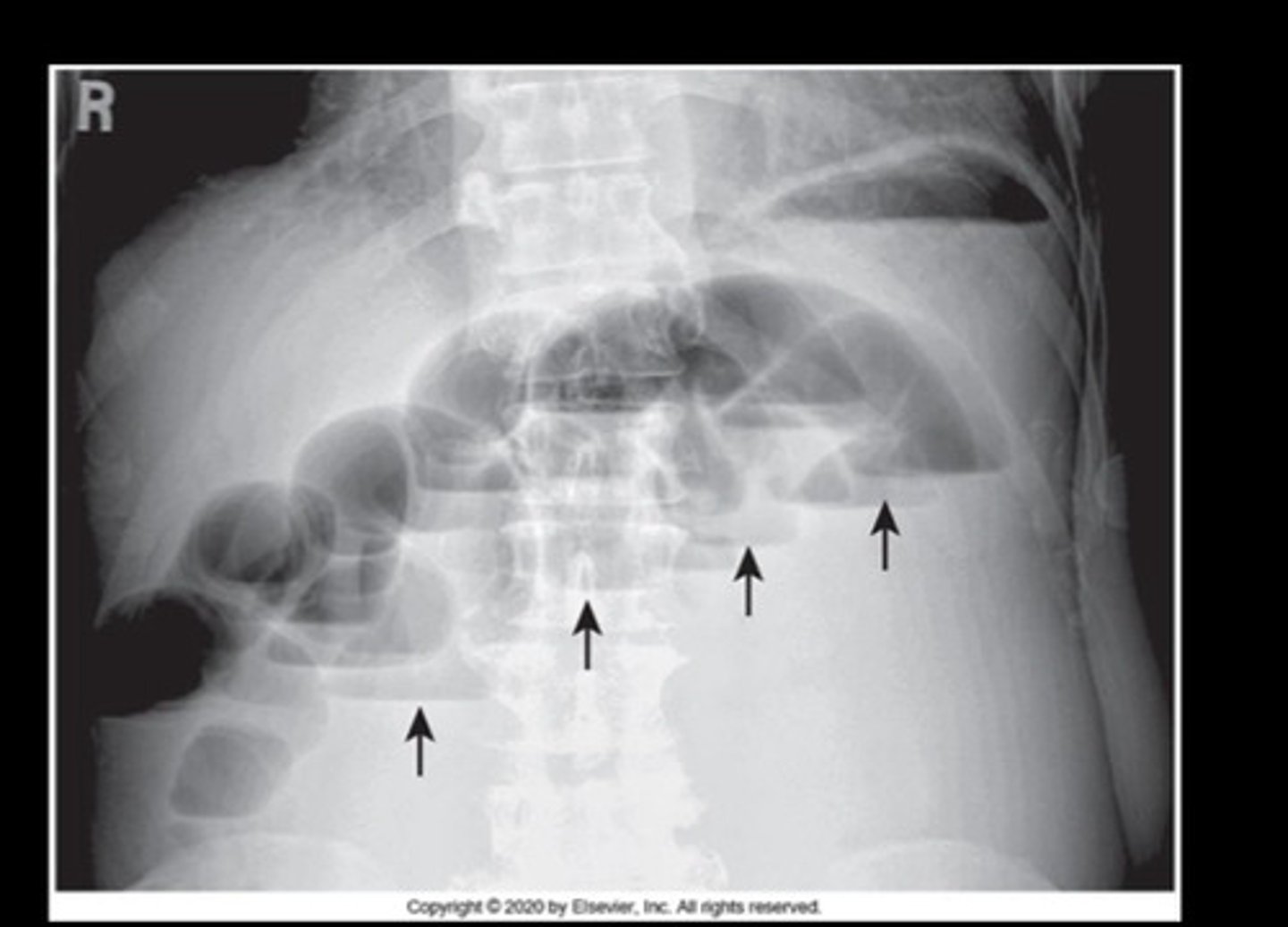 <p>"Step ladder appearance"</p><p>- may be seen on upright abd views of pt caused by arrangement of fluid filled &amp; dilated small bowel loops in a step wise configuration</p><p>-everything past the obstruction appears white</p>