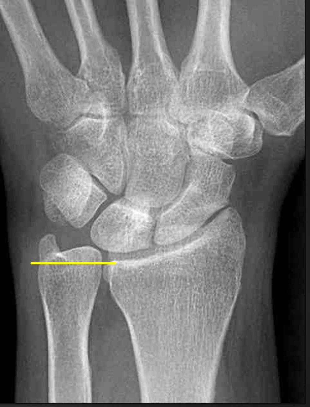 <p>what is a long ulna called and what are the ramifications </p>
