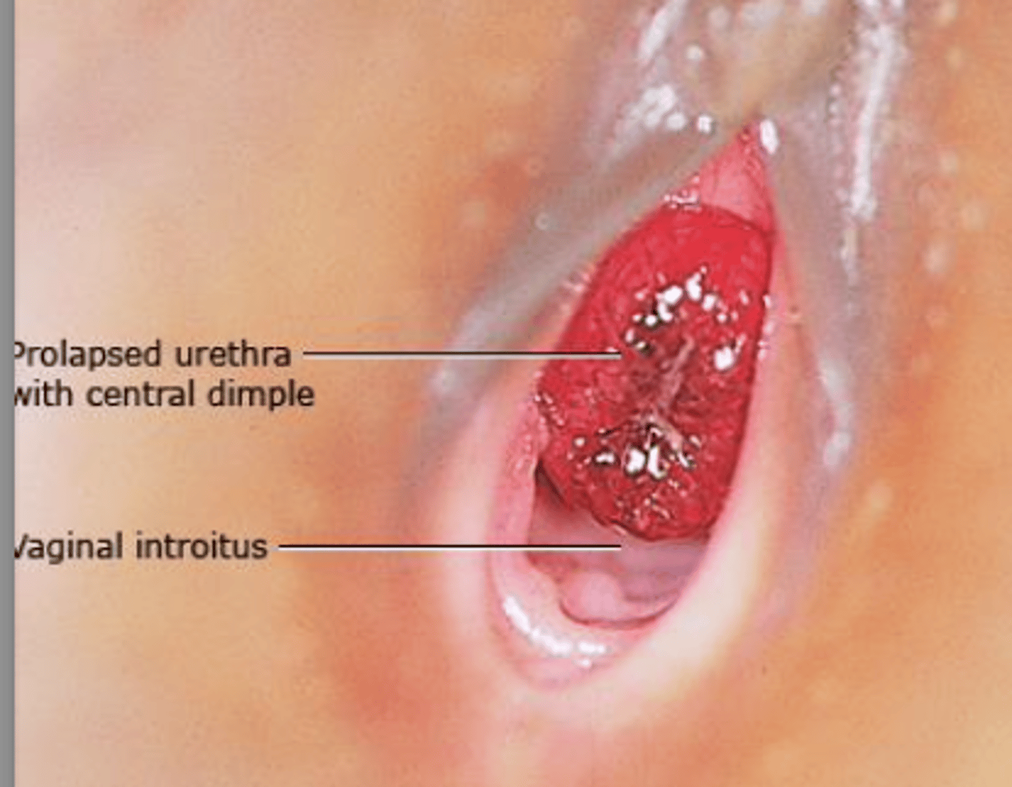 <p>-doughnut shaped protrusion mucosa is observed obscuring urethral opening</p><p>Prepubertal:</p><p>-Usually asymptomatic</p><p>-MC: vaginal bleeding due to periurethral mass</p><p>-Pain of prolapse is large, thrombosed, or necrosis</p><p>-Acute urinary retention</p><p>-Hematuria and voiding disturbances are possible but not common</p><p>-Pinkish organ congested mass may be observed at the center of the urethral meatus</p><p>-May be painful and tender to palpation</p><p>-Mucosa is ulcerated in most cases and usually bleeds upon contact</p><p>Postmenopausal:</p><p>-Often symptomatic</p><p>-Vaginal bleeding and voiding symptoms</p><p>-Hematuria</p><p>-If large → strangulation → venous obstruction, thrombosis, necrosis</p><p>-UTI</p><p>-Erythematous inflamed mucosa protruding from the urethral meatus</p><p>-Congested mucosa may appear bright red or dark and cyanotic</p><p>-Depending on the evolution of the process, the prolapsed tissue may appear infected, ulcerated, or necrotic</p>