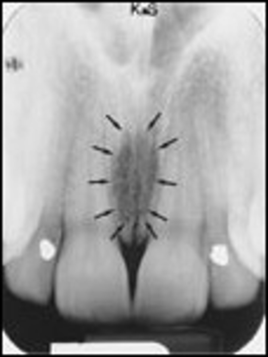<p>What is the radiolucent structure seen here?</p>
