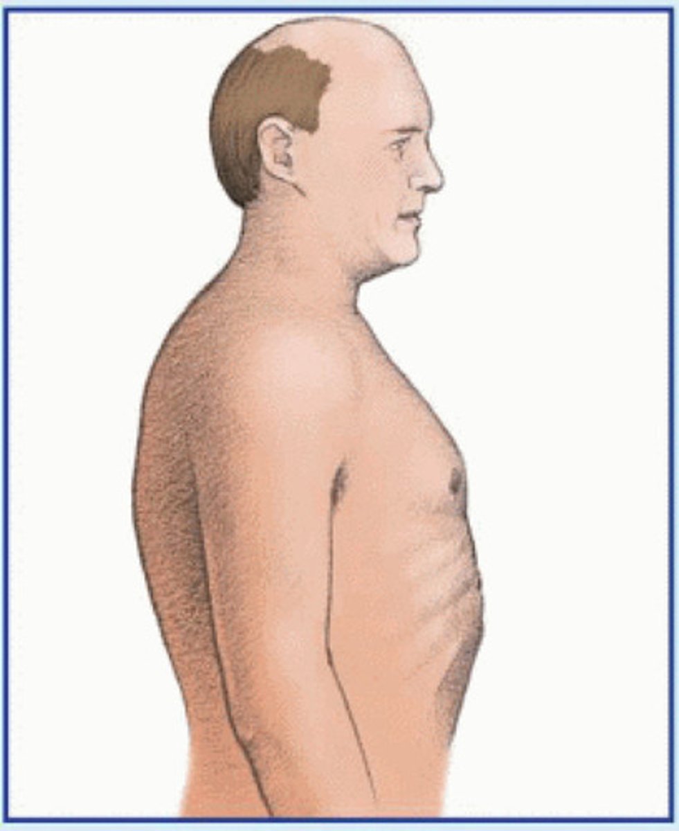 <p>Increased anterior-posterior diameter of chest</p>