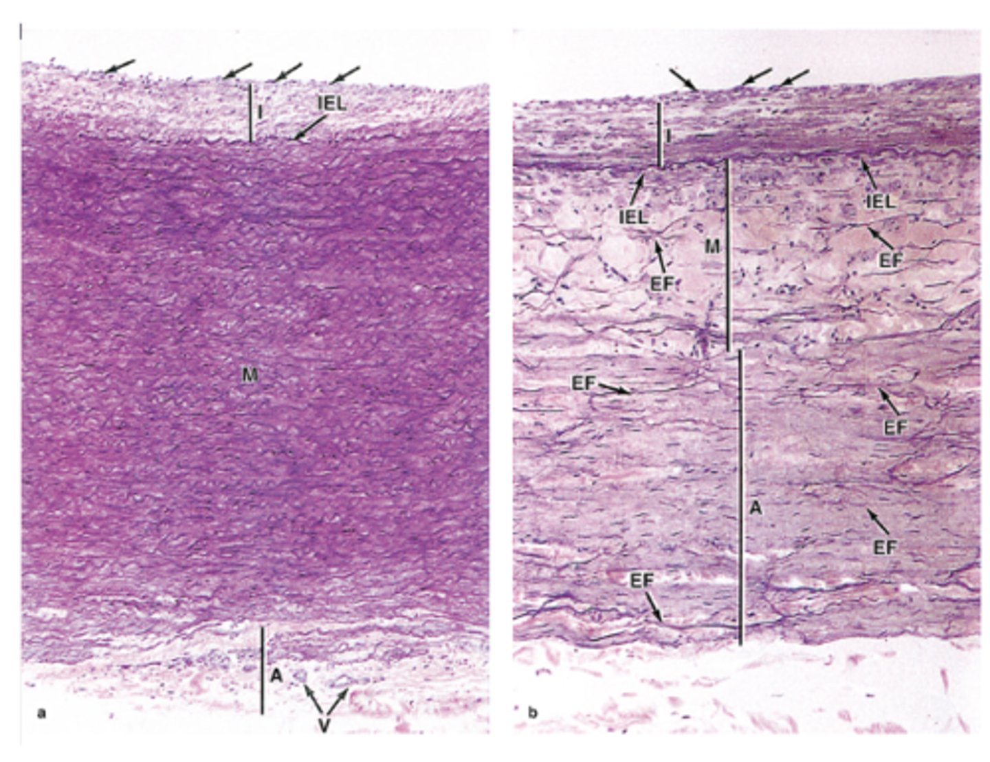 <p>In which vessels is the tunica media prominent with elastic lamellae?***</p>