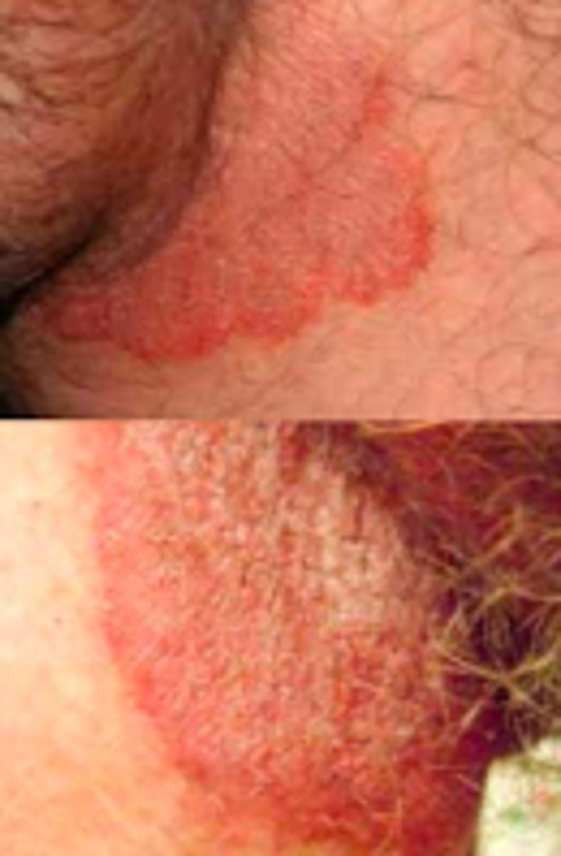 <p>Fungal ID:</p><p>Begins with erythematous or hyperpigmented patch on proximal medial thigh</p><p>- Infection spreads centrifugally, with partial central clearing and a slightly elevated, erythematous or hyperpigmented, sharply demarcated border</p><p>- Infection could spread → perineal areas, gluteal cleft, or onto buttocks</p><p>Scrotum often spared!</p>