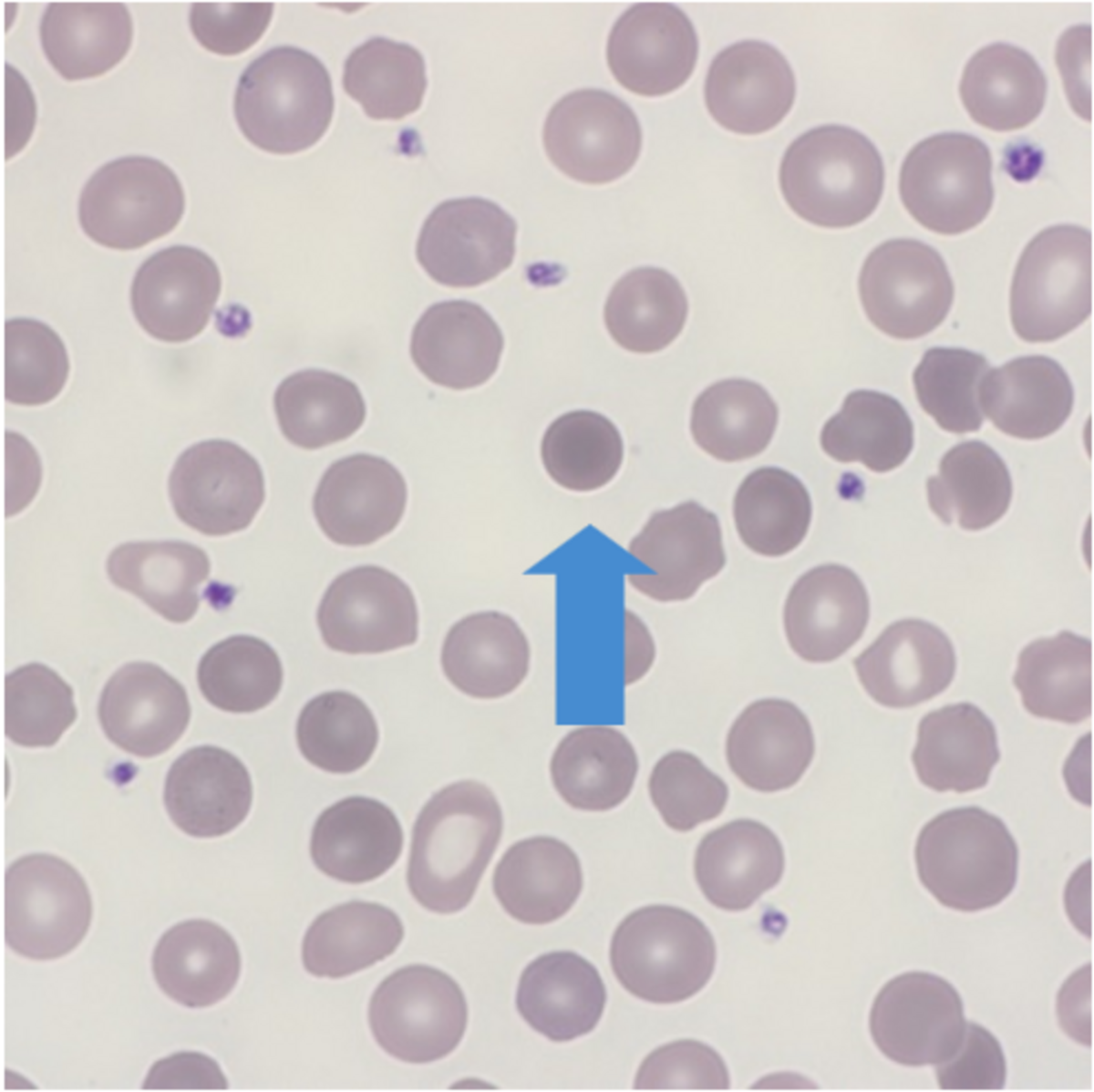 <p>Identify this type of red cell.</p>