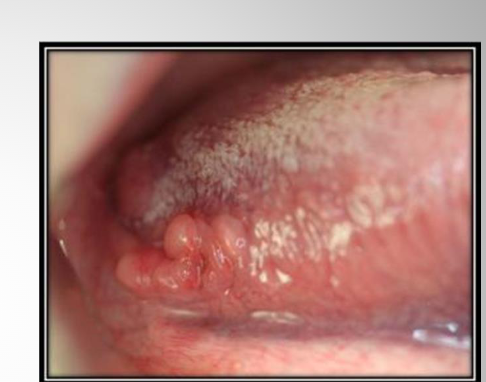 <p><span>Lingual tonsils are usually distal to foliate papillae and red, glistening papules and nodules on the posterolateral border of the<br>tongue Is the continuation of the ligual tonsil on the base of the tongue –beyond the curcumvalate papillae</span></p>