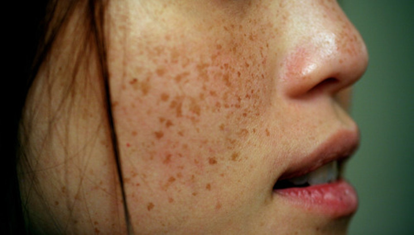 <p>Flat, well circumscribed area with change in skin color</p><p>Usually less than or equal to 1 cm</p><p>Examples include freckles, small flat mole</p>