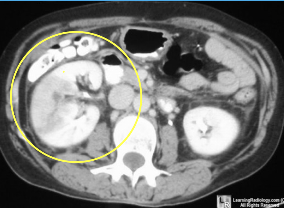 <p><em>CT Abdomen/Pelvis IV contrast</em></p>