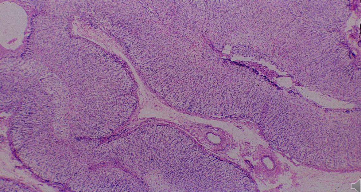 <p>Epitelio glandular endocrino en cordones y racimos</p>