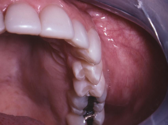 <ul><li><p>Distal femur and proximal tibia </p></li><li><p>Jaws 8% of all osteosarcomas, occur at a later age (30s)</p></li><li><p>Max = Mand (posterior)</p></li></ul><p></p>