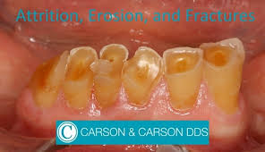 <p>PP: Chewing surfaces→worn down</p><p>CM: yellow-brown dentin→exposed (attrition)<br>gums→show roots of teeth (recession)</p>