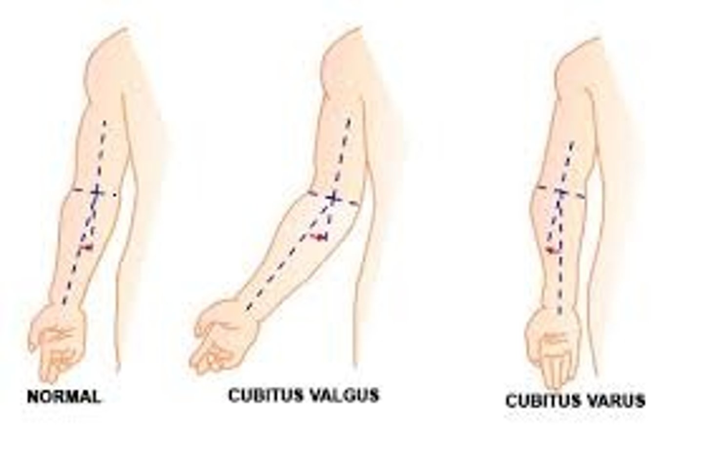 <p>Cubitus valgus</p>