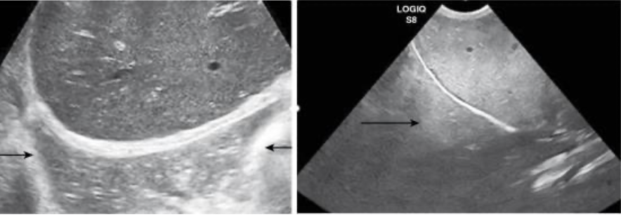 <ul><li><p>caused by highly reflective curved surfaces </p></li><li><p>produces duplicate of structure deep to reflective surface</p></li><li><p>most common - liver will appear in thorax due to diaphragm</p></li></ul><p></p>