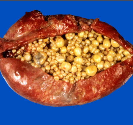 <p>inflammation of the gallbladder</p>