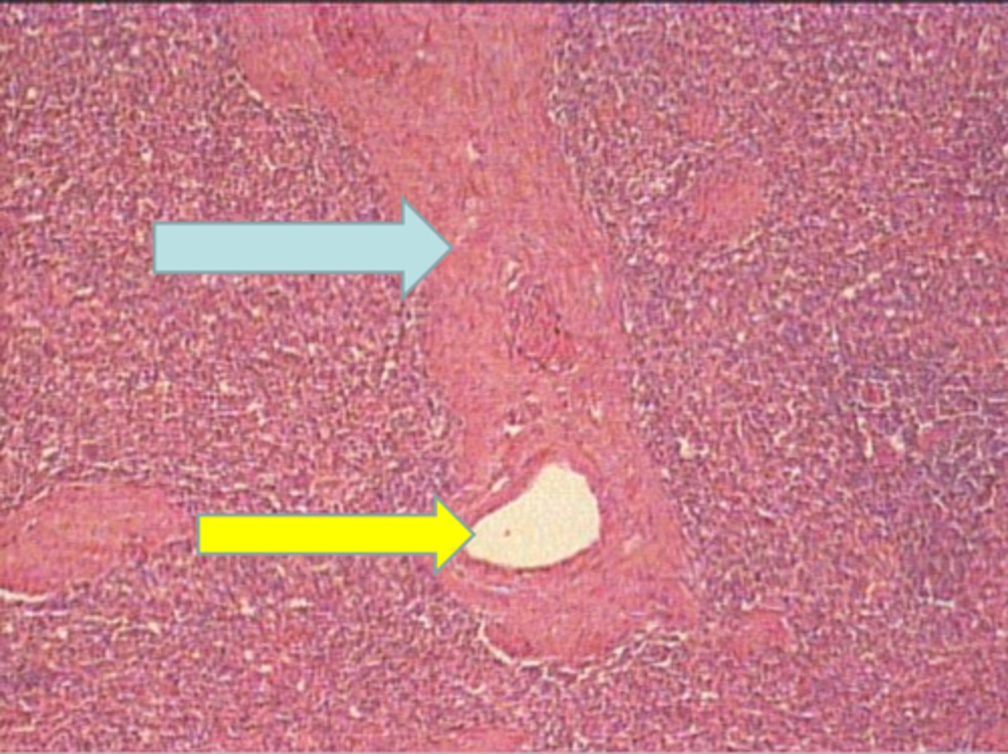 <p>yellow arrow trabecular artery</p>