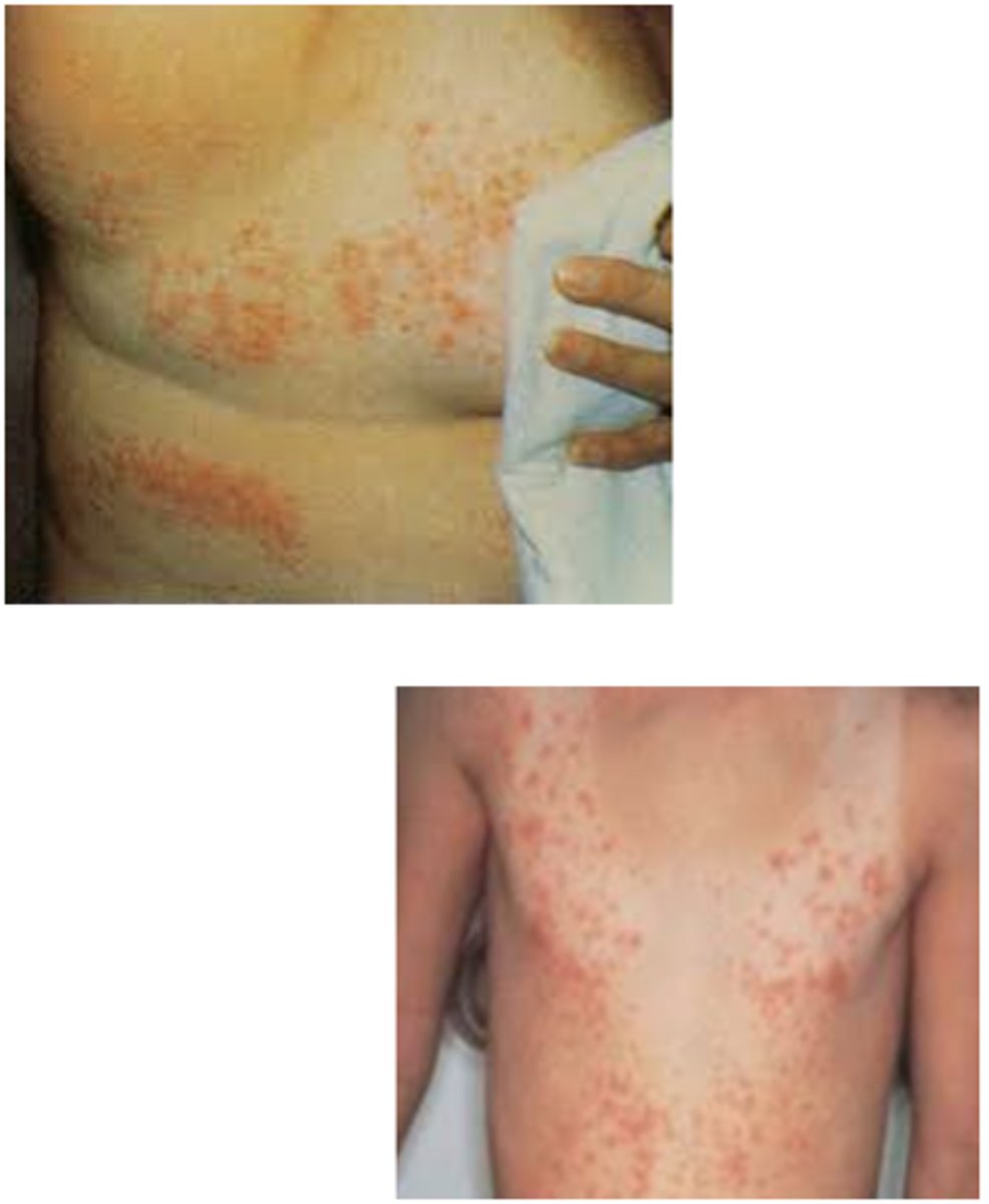 <p>sea bathers eruption → tx with benadryl, calamine lotion, hydrocortisone</p>