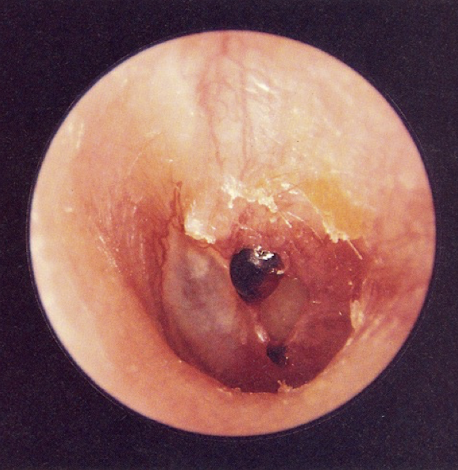 <p><u>disordered otoscopy: eardrum/TM</u></p><p>traumatic perforation</p>