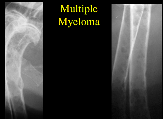 <p>Multiple Myoloma</p>