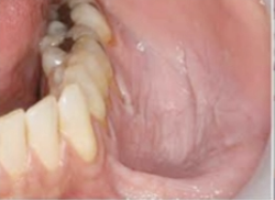 <p>What is the cause of this lesion?</p>
