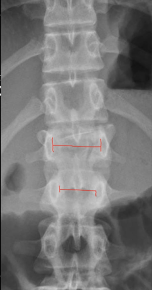 <p>_____ is when the interpedicular space narrows as you descend the lumbar spine</p>