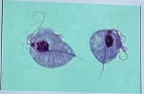 <p>Trichomonas vaginalis symptom in female (1) (is considered STD)</p>