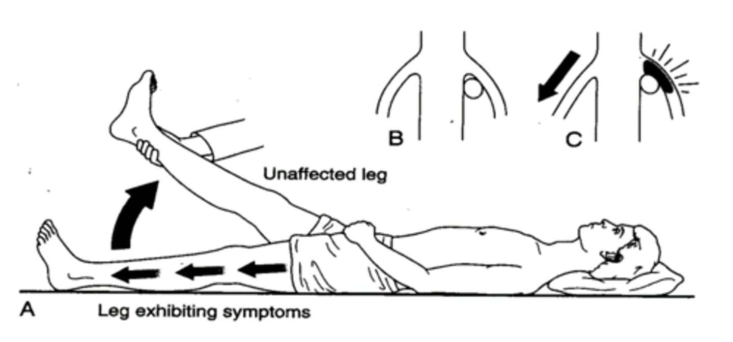 <p>test for herniation; have the patient lay supine. The examiner will passively flex the patient's uninvolved hip while maintaining the knee in full extension. A positive test is considered when the patient reports reproduction of pain in the involved limb at 40 degrees of hip flexion or less in the uninvolved limb. The examiner should make note of the degree of hip flexion where the patient reported pain or reproduction of symptoms.</p>