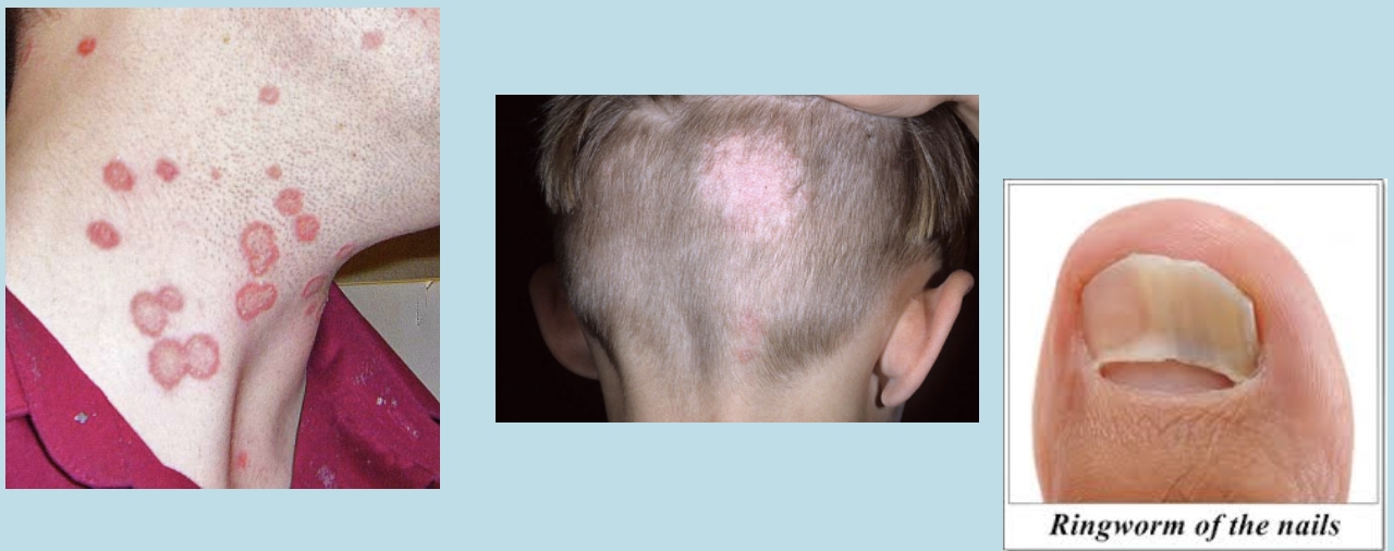 <ul><li><p>Itchy, red, raised, scaly patches that may blister and ooze. - The patches often have sharply-defined edges, they are often redder around the outside with normal skin tone in the center (This may create the appearance of a ring)- When your scalp or beard is infected, you will have bald patches.- If nails are infected, they become discolored, thick, and even crumble.</p></li></ul>