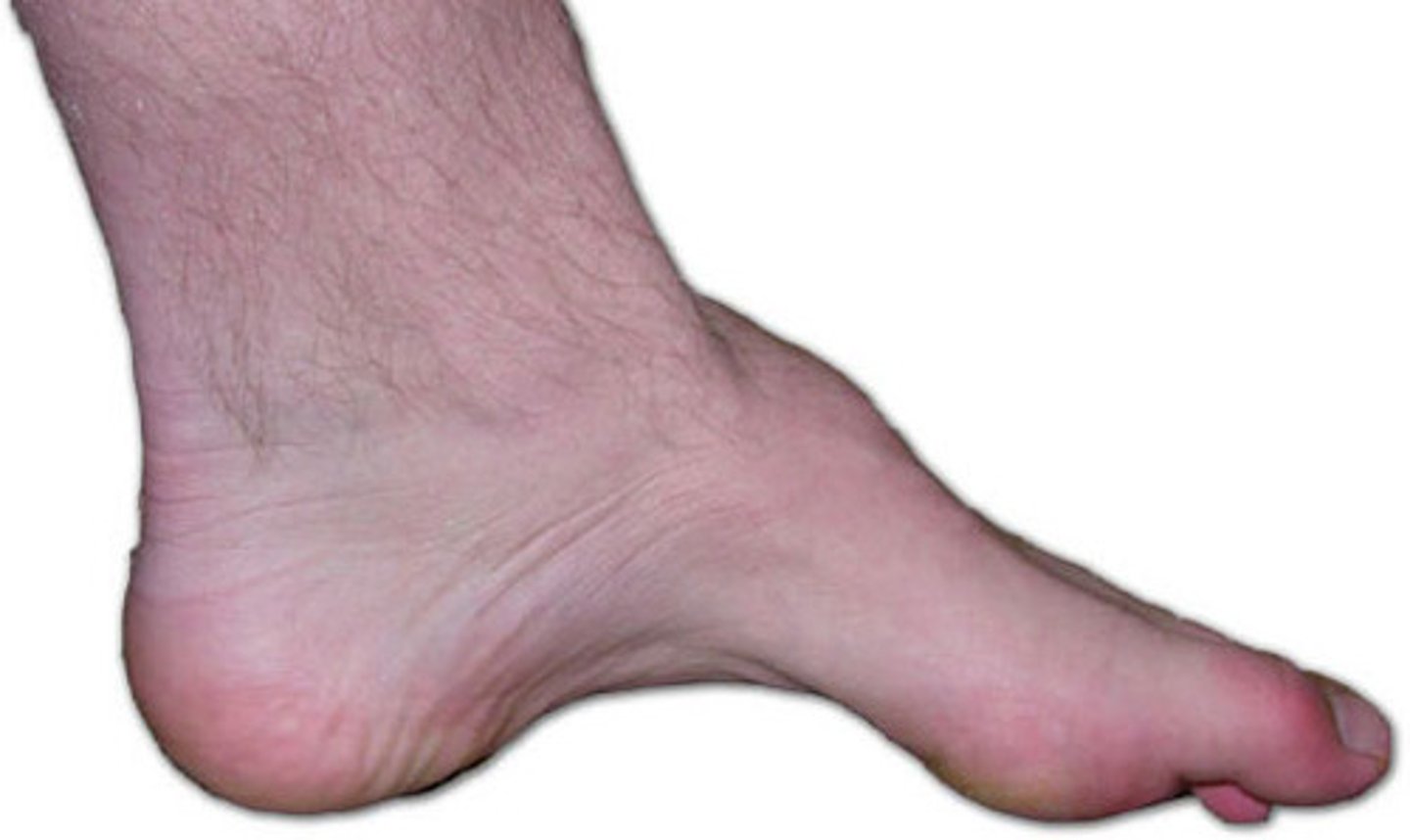 <p>Often associated with neuromuscular conditions (ex: Charcot-Marie-Tooth)</p><p>"high arches"</p>