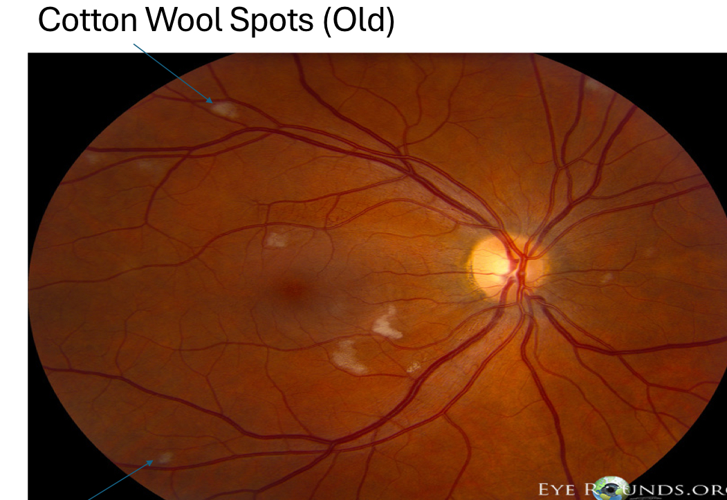 <p>resolves in 3-4 months</p><ul><li><p>CWS will get smaller, waxy, more gray color</p></li><li><p>after resolution → localized atrophy of ganglion cells and nerve fibers → leads to “<strong>depression</strong>” sign</p></li><li><p>if a CWS or depression sign is large enough → lead to VF defect</p></li></ul><p></p>