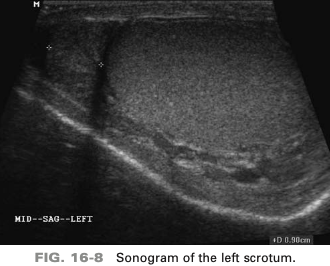 <p>a 45-year-old patient presents with acute scrotal pain after. mountain-biking trip. On the basis of this clinical history, the sono findings are suspicious for </p>