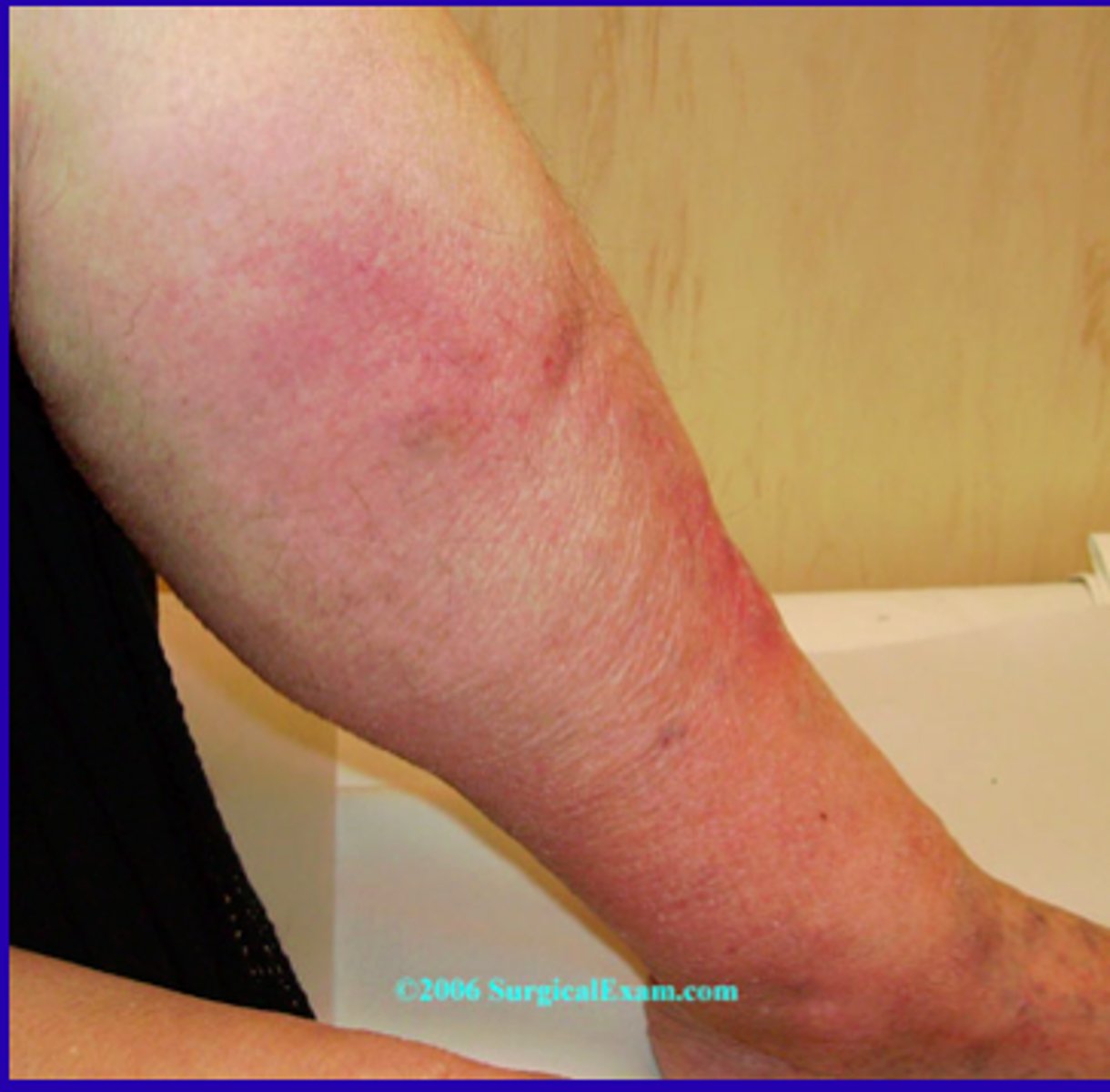 <p>inflammation of a vein associated with a clot formation</p>