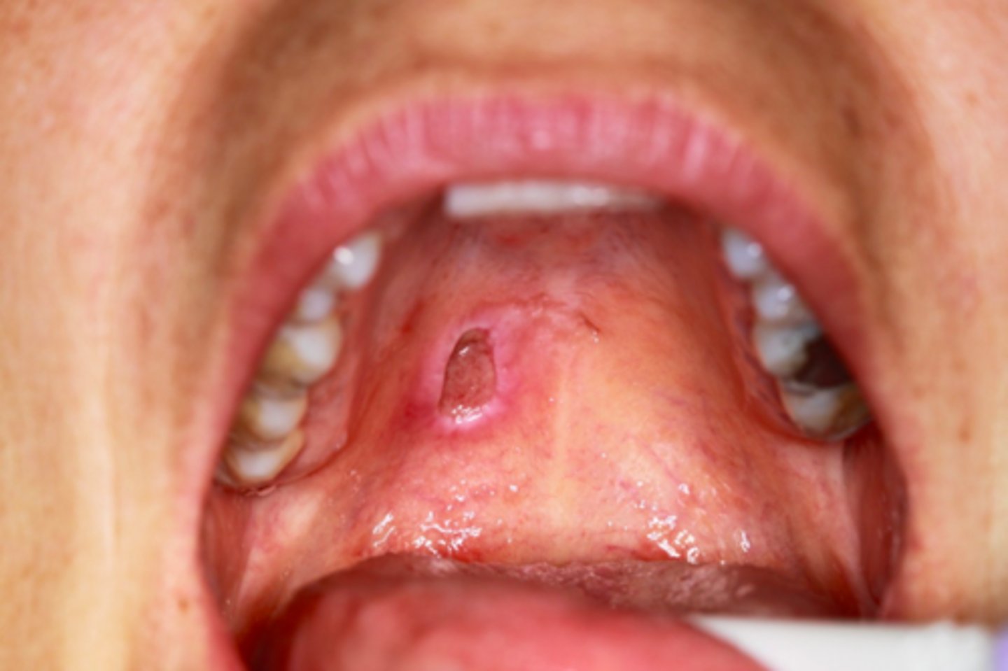 <p>Patient presents with <strong>single ulceration on the hard palatal </strong>mucosa. Patient claims it "used to be red and swollen, now it's like a <strong>crater</strong>". Histo path report reveals <u>Acinar necrosis</u> with preservation of lobular architecture,<u> squamous metaplasia and Pseudoepitheliomatous hyperplasia</u>. What is the diagnosis?</p>