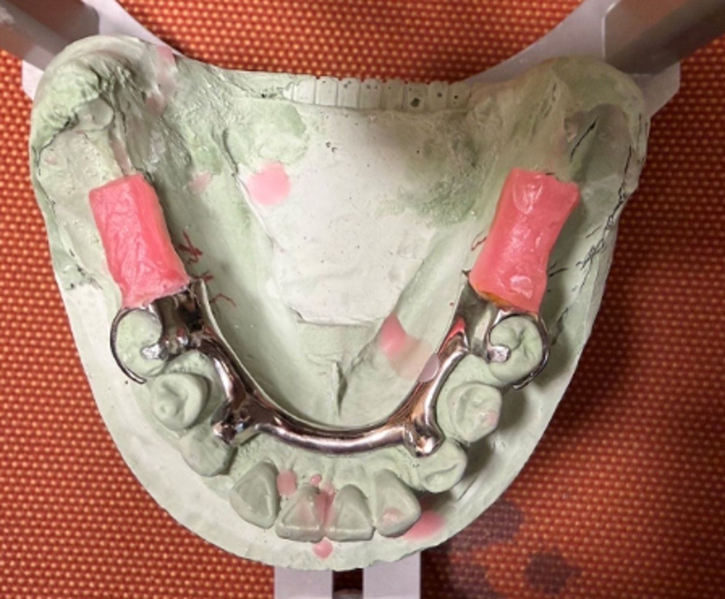 <p>Did the student use proper type of dental stone to form this working cast for the dental prostheses?</p>