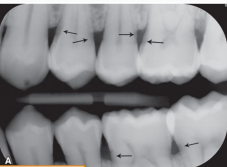 <p>caries or cervical burn out </p>