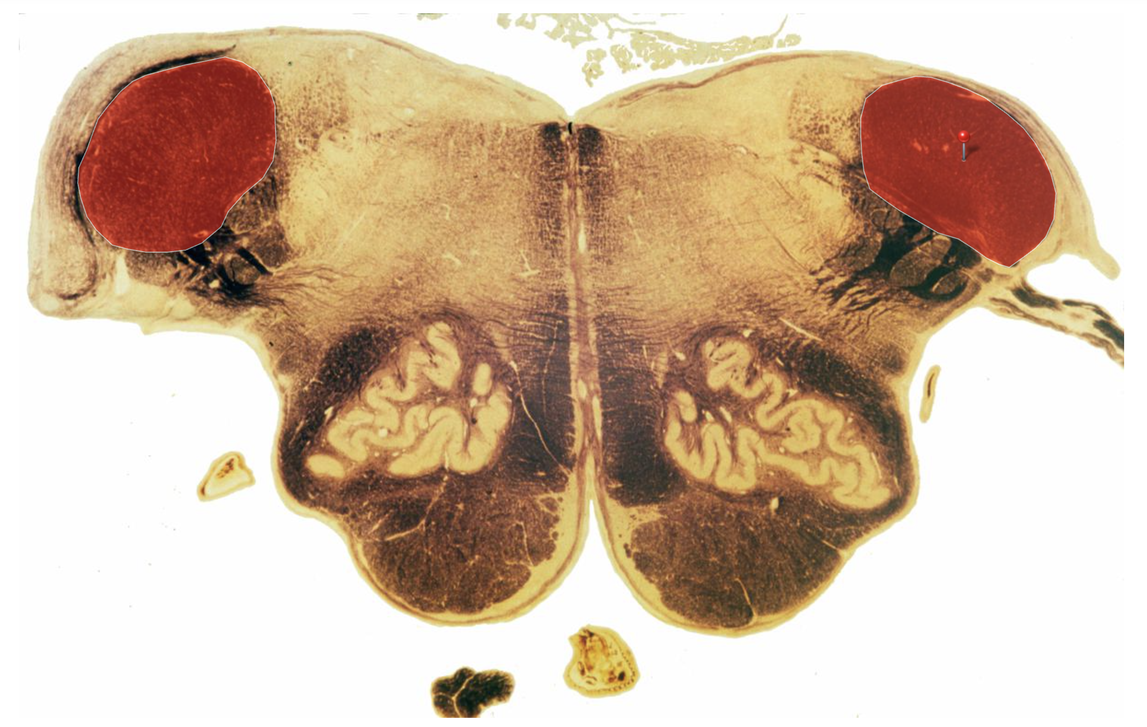 <p>Inferior Cerebellar Peduncle + Pontomedullary Junction</p>