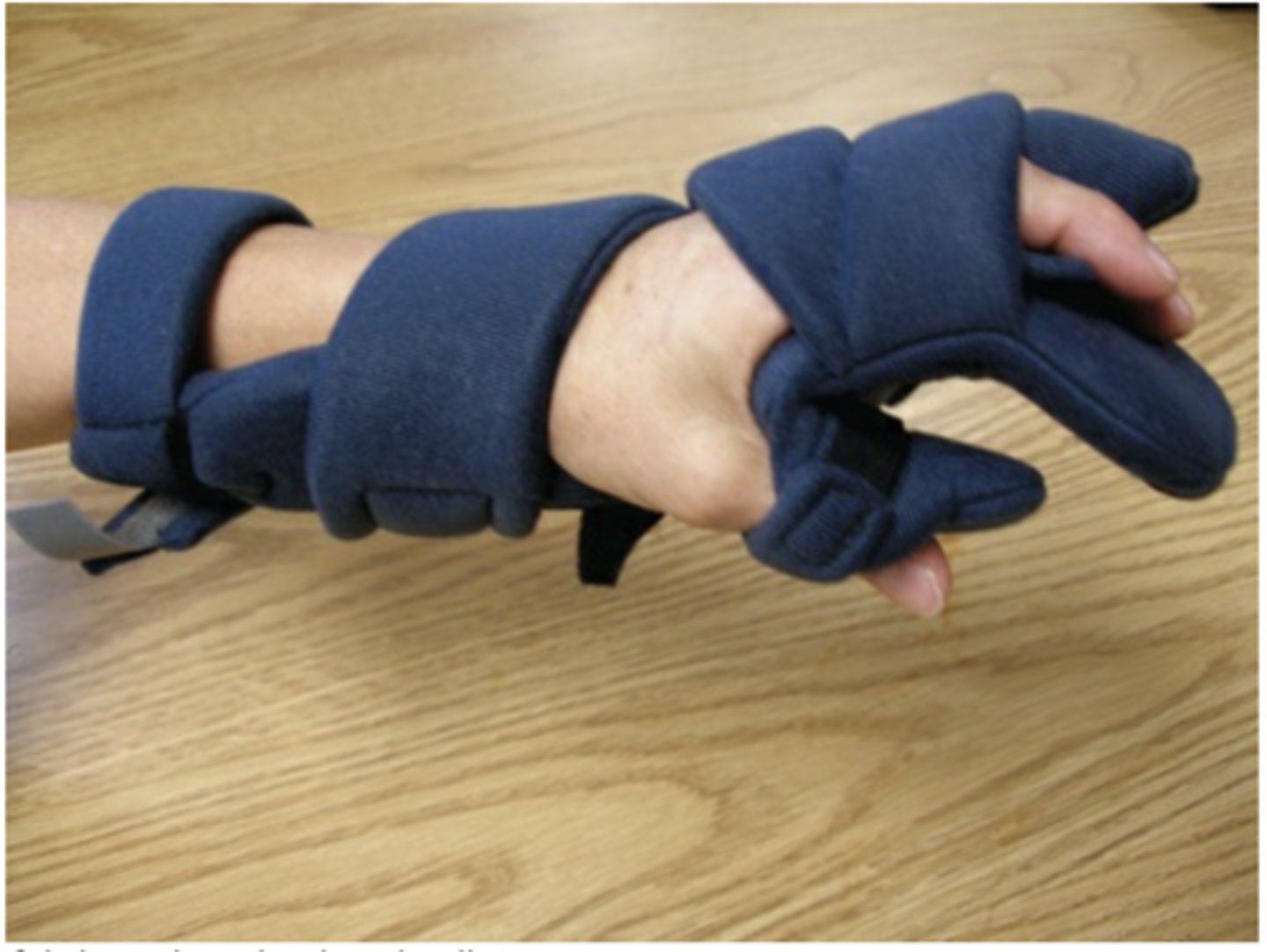<p>Resting splints to decrease acute inflammation, decrease pain, protect joints</p>