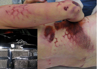 <p>abrasion caused by crushing of superficial layers of skin; associated with bruise of surrounding area; force less, duration more</p>