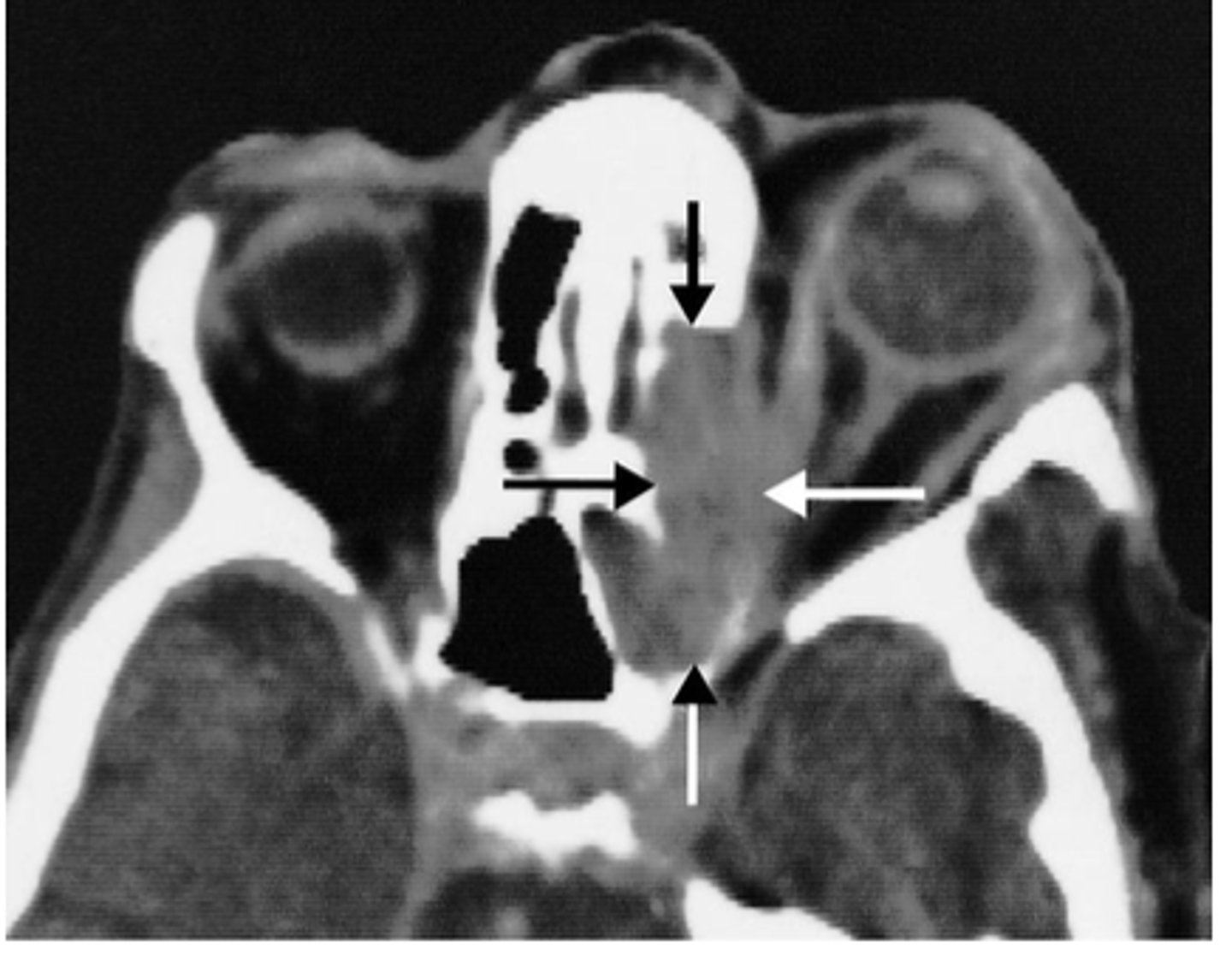 <p>enlargement of the EOM frequently bilateral</p>