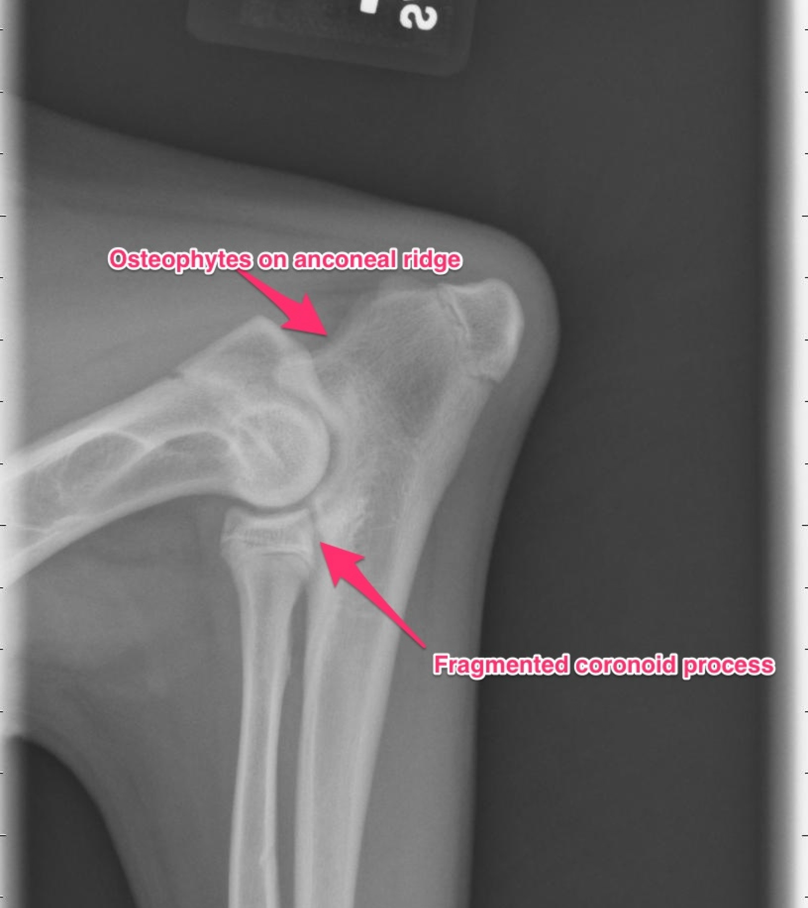 <p><strong>fragmented coranoid process (FCP)</strong></p><ul><li><p>presence of fracture or irregularity in the processus coranoideus of ulna.</p></li><li><p>fragment size: rice, corn, fragment has three forms - loss of the tip of coranoid processus, fragmentation at the junction of ulna and radius, fissure or erosion on articular cartilage.</p></li><li><p>key features: fracture line, fragmentation, soft tissue swelling, joint alignment, associated inuries.</p></li><li><p>clinical signs: more males, 50% not lame at young age, lameness only after damage of articular cartilage, excess body weight.</p></li></ul><p></p>