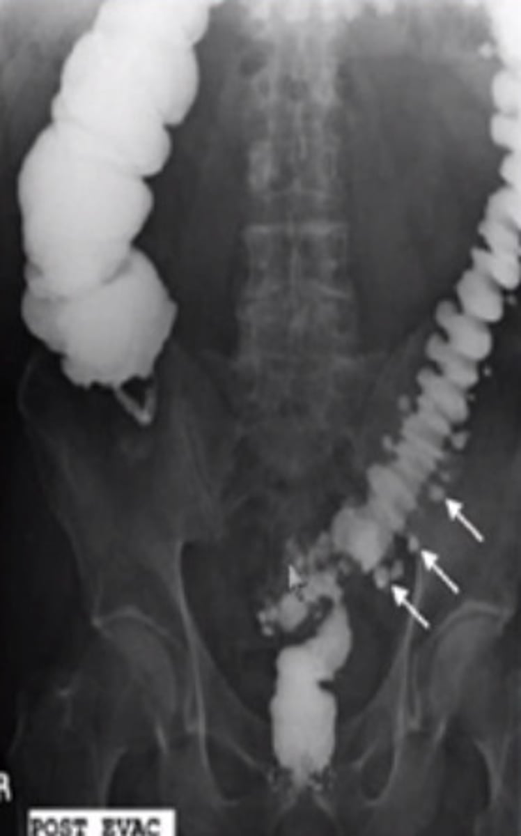 <p>outpouchings of colon, uncertain etiology, 90% pts asymptomatic, some pts have chronic constipation, abdominal pain, fluctuating bowel habits</p>