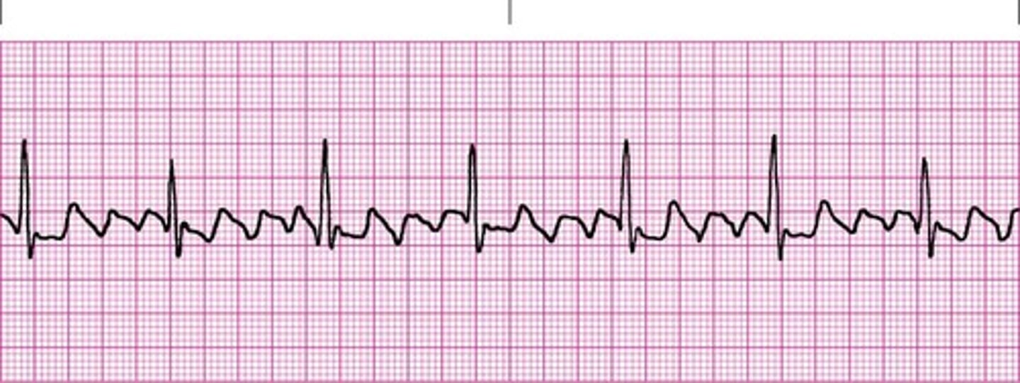 <p>saw tooth, Multiple P waves</p>