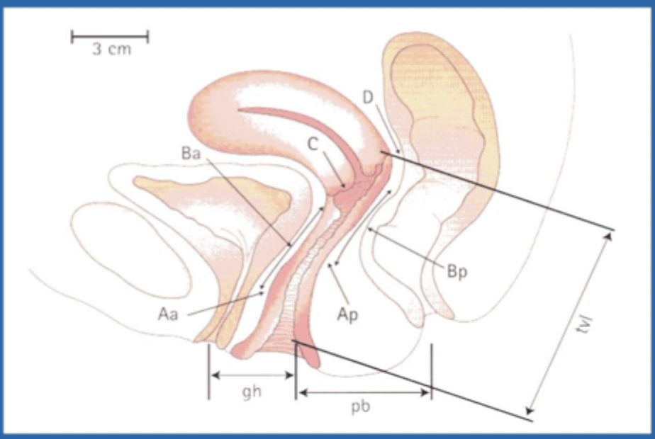 <p>Staging is based on position of vaginal walls relative to the hymen (stage II is -1 - + 1)</p>