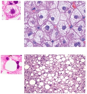 <p>drobnokropelkowe - liczne drobne wakuole cytoplazmatyczne w jednym hepatocycie</p><p>wielkokropelkowe - jądro hepatocyta zepchnięte na obwód przez wakuolę zawierającą tłuszcz (jedna duża wakuola cytoplazmatyczna)</p>