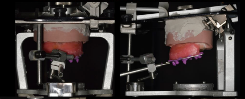 <ul><li><p>Se mezcla yeso piedra tipo III o IV según recomendación. </p></li><li><p>Se coloca yeso sobre la platina superior. </p></li><li><p>Se baja suavemente el brazo superior del articulador hasta que el modelo quede asentado en la posición registrada por el arco facial. </p></li><li><p>Se mantiene firme hasta el fraguado.</p></li></ul><p></p>