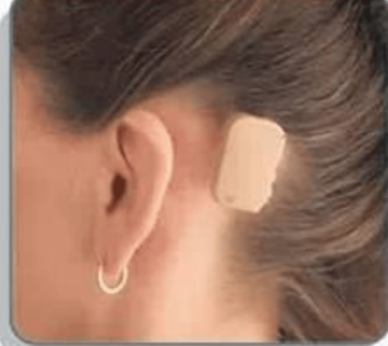 <p>-Oscillator placed directly on the mastoid to transmit stimuli to the cochlea.</p><p>-Snap surgically implanted into mastoid and the hearing aid clips into the snap.</p><p>-This is for conductive hearing loss when it cannot be fixed if referred out. Non repairable conductive loss</p><p>-Problem with this is sound localization difficulties. Because bone conduction stimulates both cochlea</p>