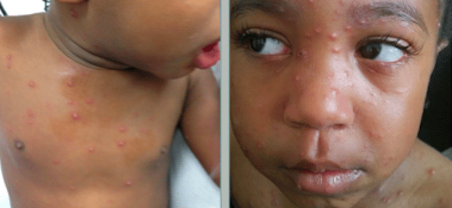 <p>Viral Skin Infections:</p><p>- <strong>highly contagious primary infection characterized by pruritic vesicles that evolve into crusts &amp; scars</strong></p><p>- mostly affects &lt;10 y/o</p><p>- transmission includes<strong> direct contact &amp; airborne droplets</strong> (VERY contagious even before rash &amp; until the last crop of vesicles crust over)</p>