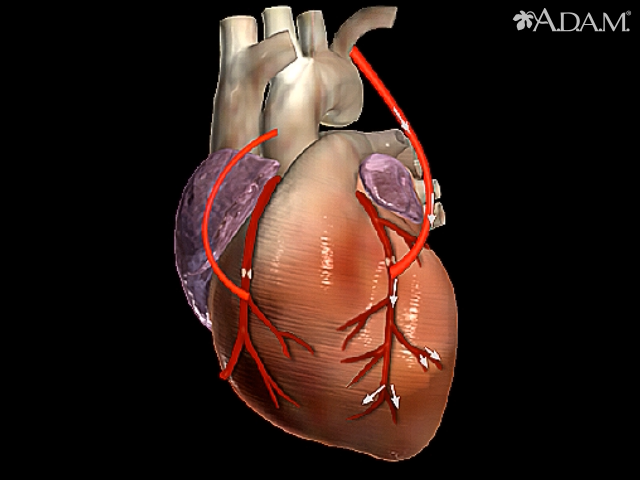 <p>-A vein from the leg is reattached around clotted coronary artery to maintain blood flow</p><p>-Used when arteries are too clogged for angioplasty to work</p>