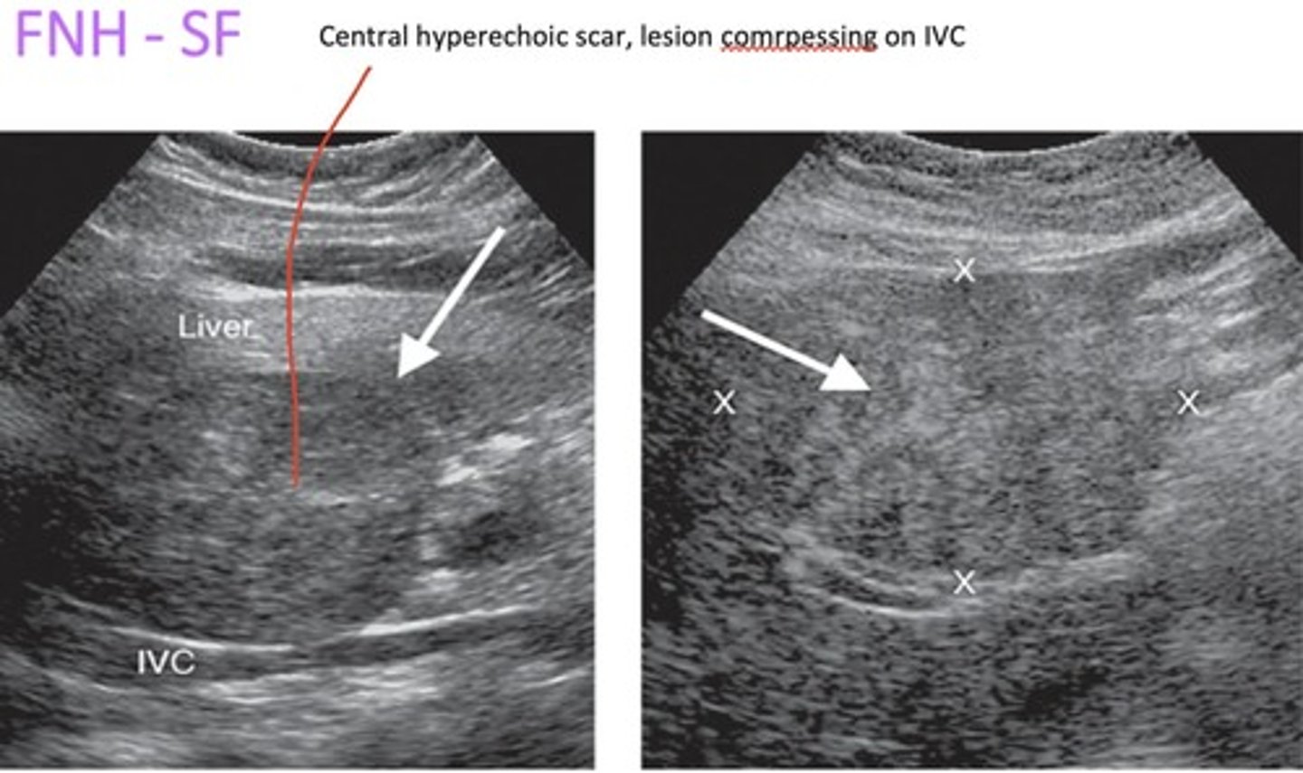 <p>Other tests:</p><p>- Doppler - stellate vessels (rich vasculature in centre of mass)</p><p>- CEUS, biopsy</p>