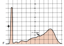<p>Determine the condition of the patient given the serum electrophoresis graph</p><img src="https://knowt-user-attachments.s3.amazonaws.com/9034579b-1253-4c7b-9f68-16ac01484cca.png" alt="knowt flashcard image"><p>A. Inflammation</p><p>B. Liver Cirrhosis</p><p>C. Nephrotic Syndrome</p><p>D. Liver Cirrhosis</p><p>E. NOTA</p>